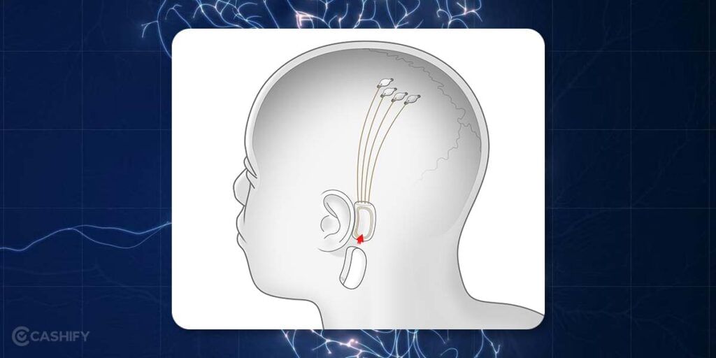Neuralink Brain Implant